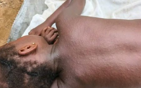 Measles Outbreak in Todee Claims One Life, Leaves Several at Risk