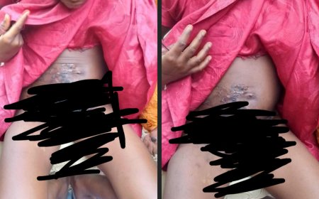 Stepmother Allegedly Pours Boiling Water on 11-Year-Old Girl