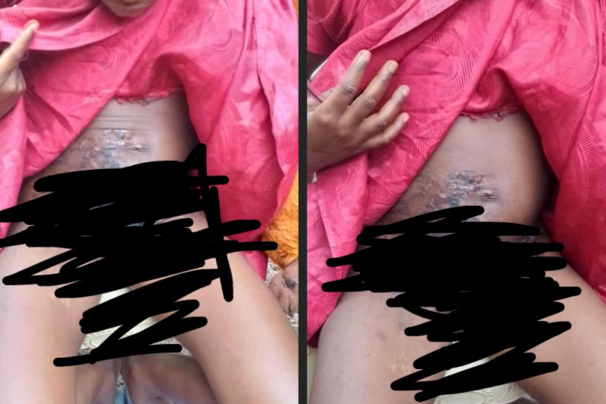 Stepmother Allegedly Pours Boiling Water on 11-Year-Old Girl